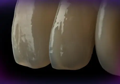 Set of the teeth for М2-LUX