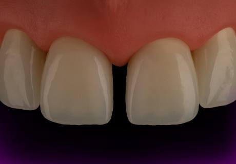 Dental phantom M2-PRO diastema