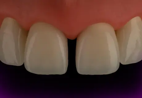 Dental phantom M2-PRO diastema