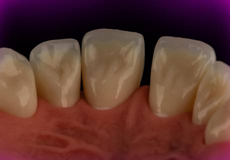 Dental phantom M2-PRO diastema