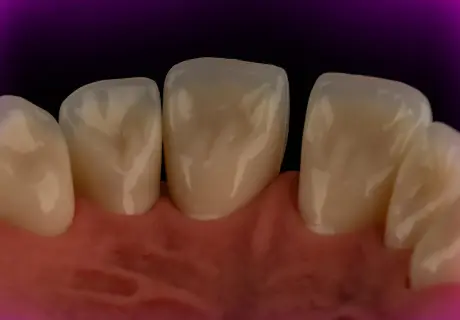 Dental phantom M2-PRO diastema