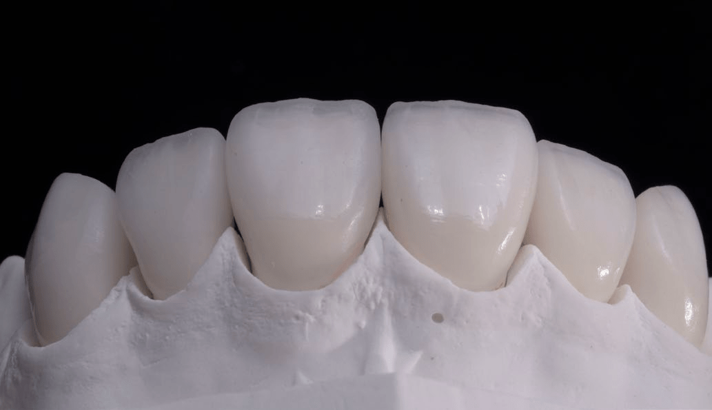 Harmony of smile design in the facial context