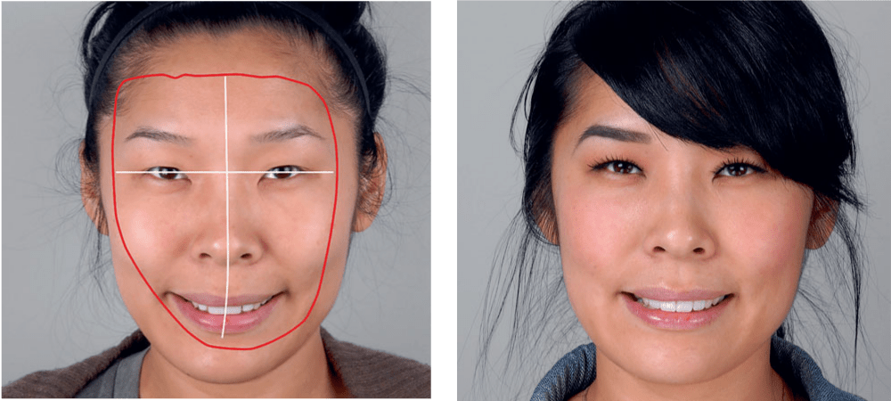 Smile makeover and the oral facial harmony concept in a new era