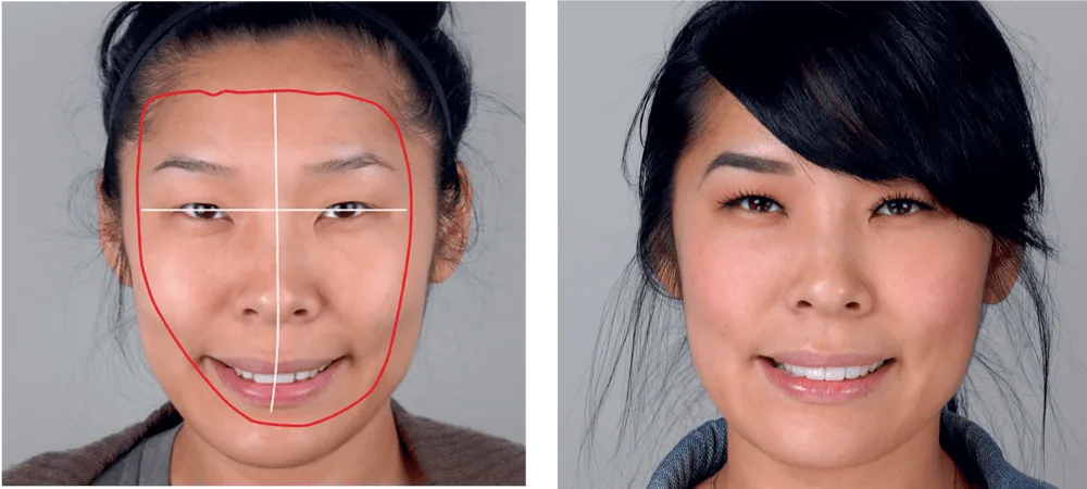 Smile makeover and the oral facial harmony concept in a new era