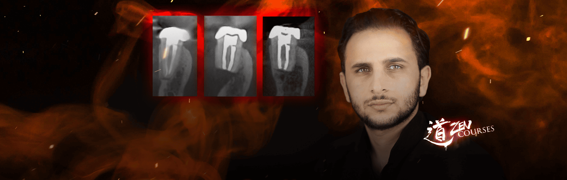 Microapical Surgery, the last card in retreatments