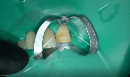 Как работает силан / How to Dentist