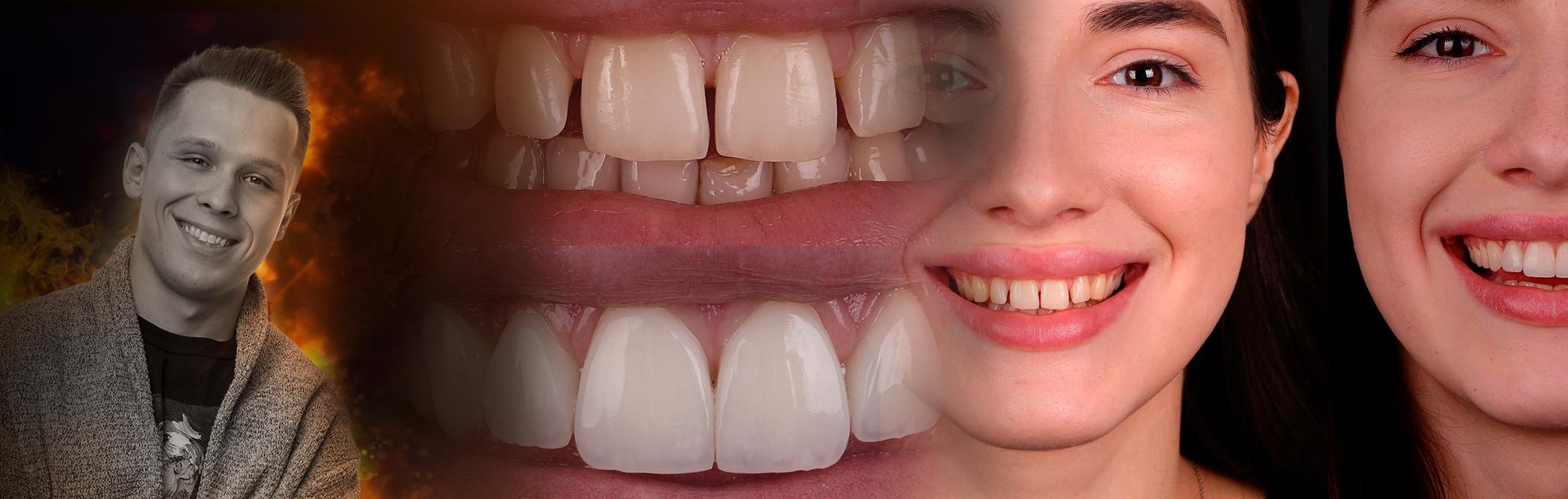 Direct restoration NO-PREP