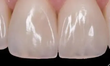 Fragmental restoration of 3 and 4
