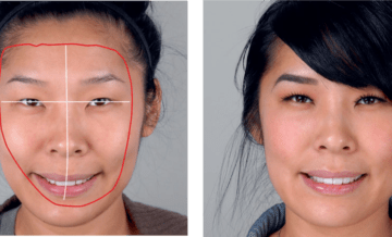 Smile makeover and the oral facial harmony concept in a new era