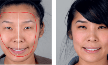Smile makeover and the oral facial harmony concept in a new era