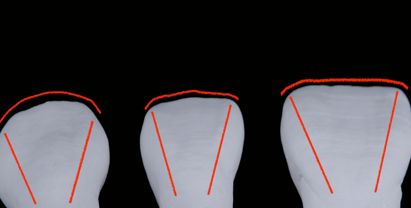 Dental Anatomical Combinations: A Guide to Ultimate Dental Esthetics